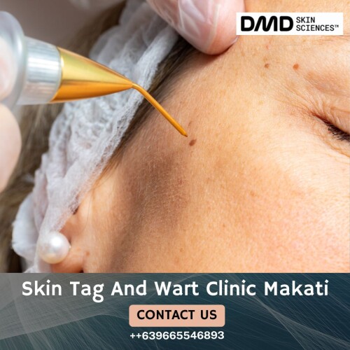 Trusted-Skin-Tag-and-Wart-Clinic-Makati.jpg